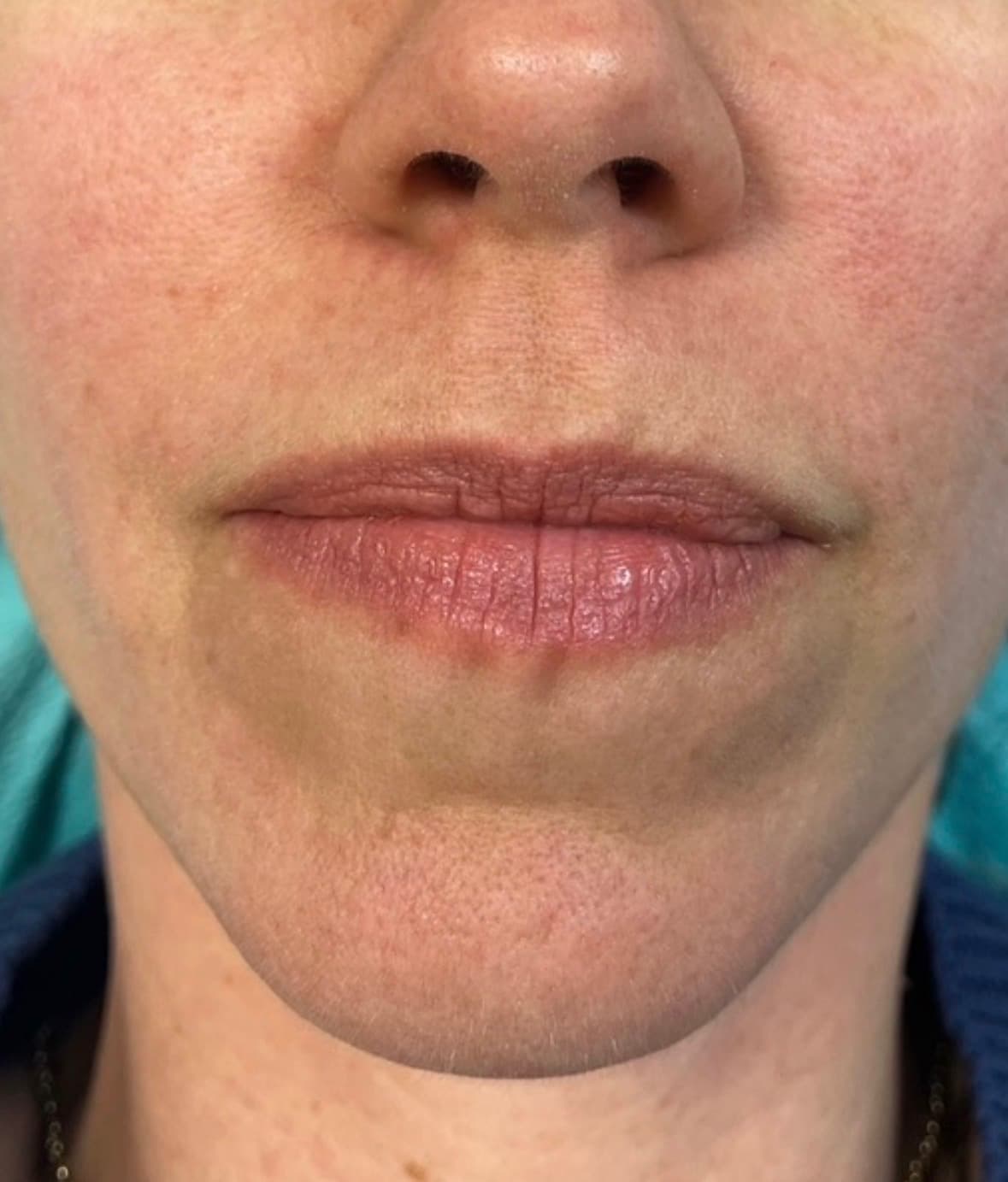 Before photo for one BBL treatment.