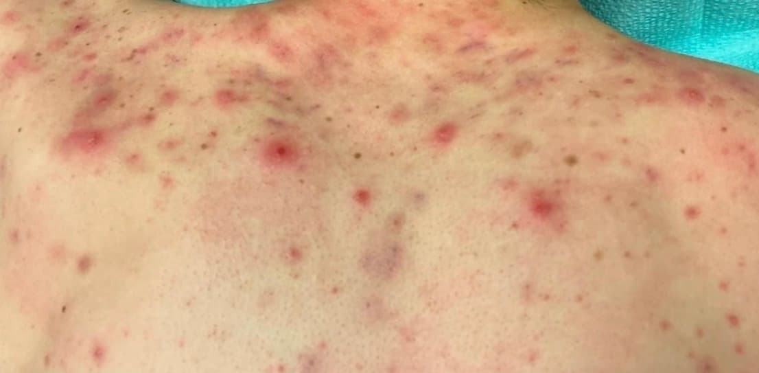 Before photo for body acne treated with laser and body treatments.