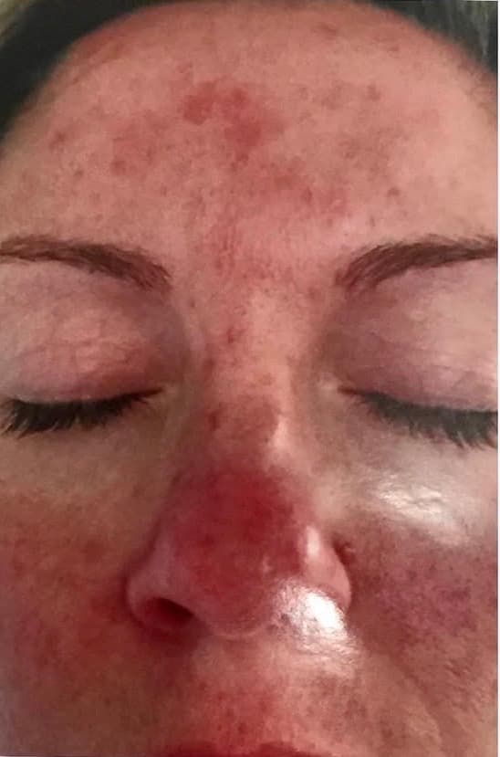 Before photo for microneedling and peels over 7 months.